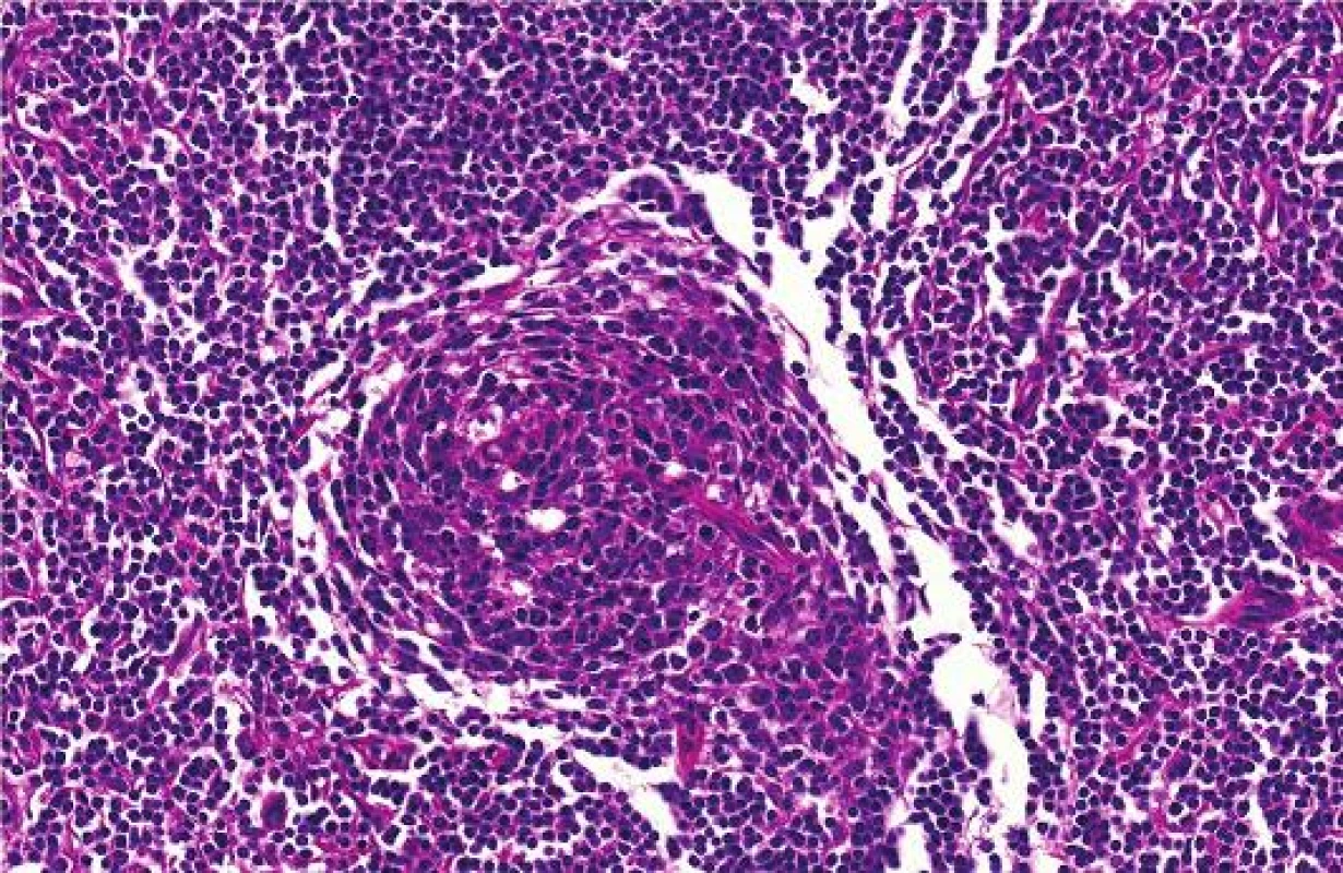 Detailní histologické zobrazení Castlemanovy choroby
Fig. 4 : Detailed image of Castleman´s disease