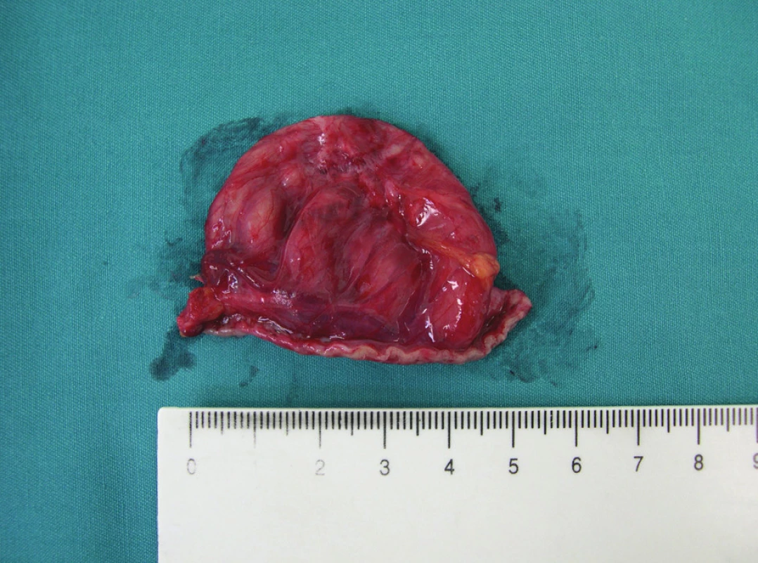 Resekát divertikula žalúdka
Fig. 5: Specimen of the gastric diverticulum after resection