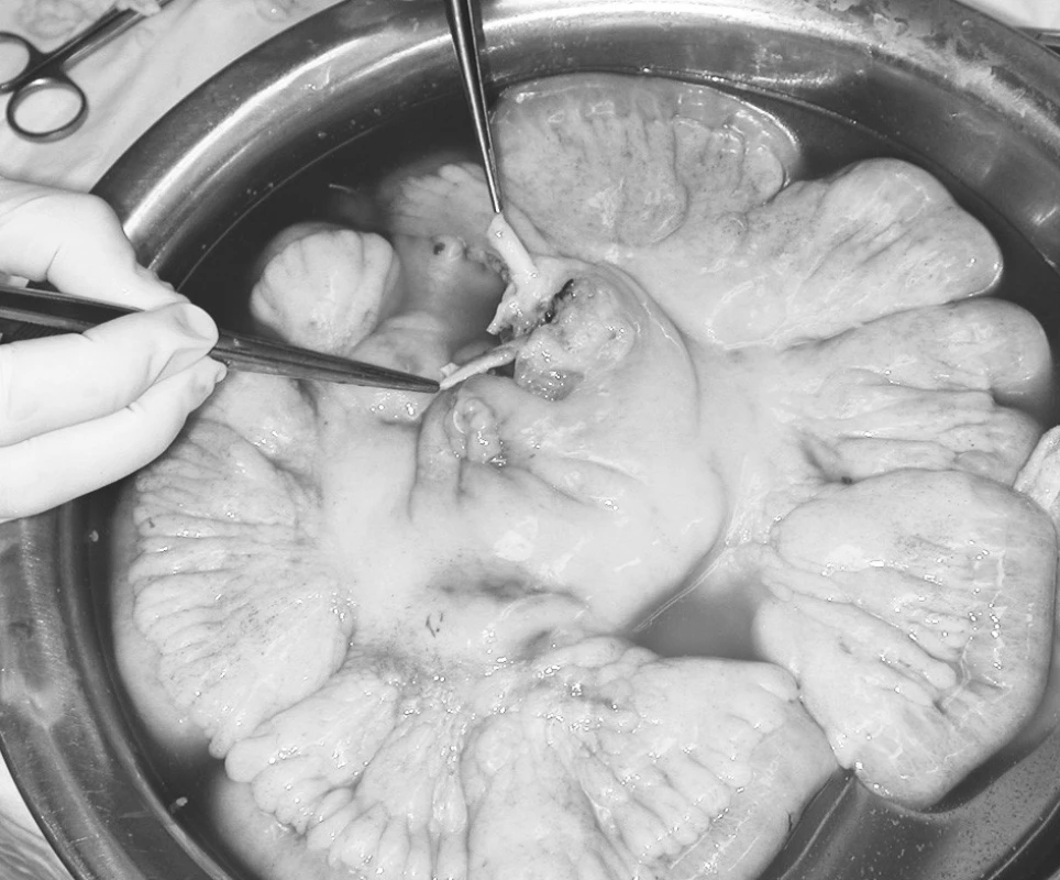 Odebraný štěp tenkého střeva. V pinzetách a. mesenteria superior a v. mesenteria superior
Pic. 2. The collected small intestinal graft. The a. mesenteria superior and v. mesenteria superior held in pincers