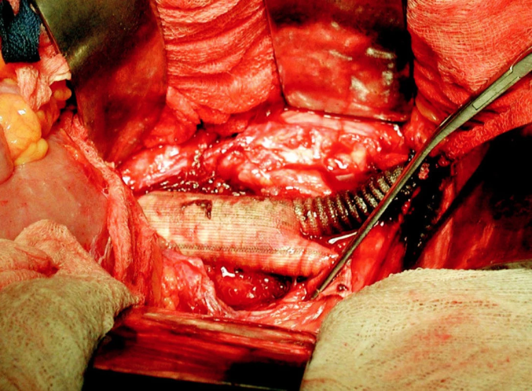 Infikovaná bifurkační protéza (peroperační foto)
Fig. 1. Infected bifurcation prosthesis (peroperative view)