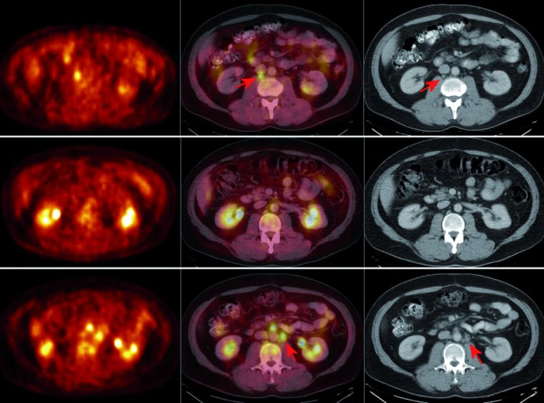 Fúze 18F-FDG PET/CT – všechny 3 řezy jsou lokalizovány přibližně do úrovně dolního okraje jater. A. před zahájením léčby, B. v jejím průběhu, C. při progresi onemocnění.
A. V květnu 2005 je znatelný hypermetabolizmus glukózy v retrokavální lymfatické uzlině.
B. V průběhu léčby – v listopadu 2005 – pak dochází k vymizení konzumpce glukózy. C. V září 2006 je detekován hypermetabolizmus glukózy ve více uzlinách v retroperitoneu.
