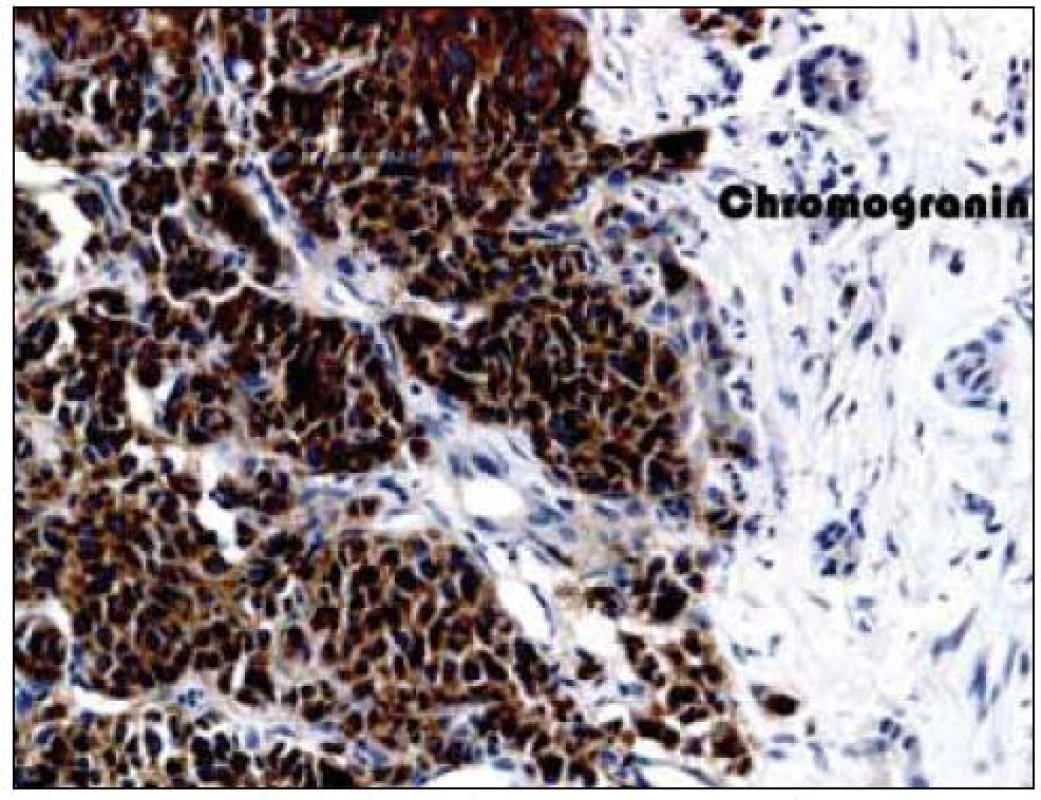 Imunohistochemické vyšetření jaterního parenchymu, pozitivita chromograninu.