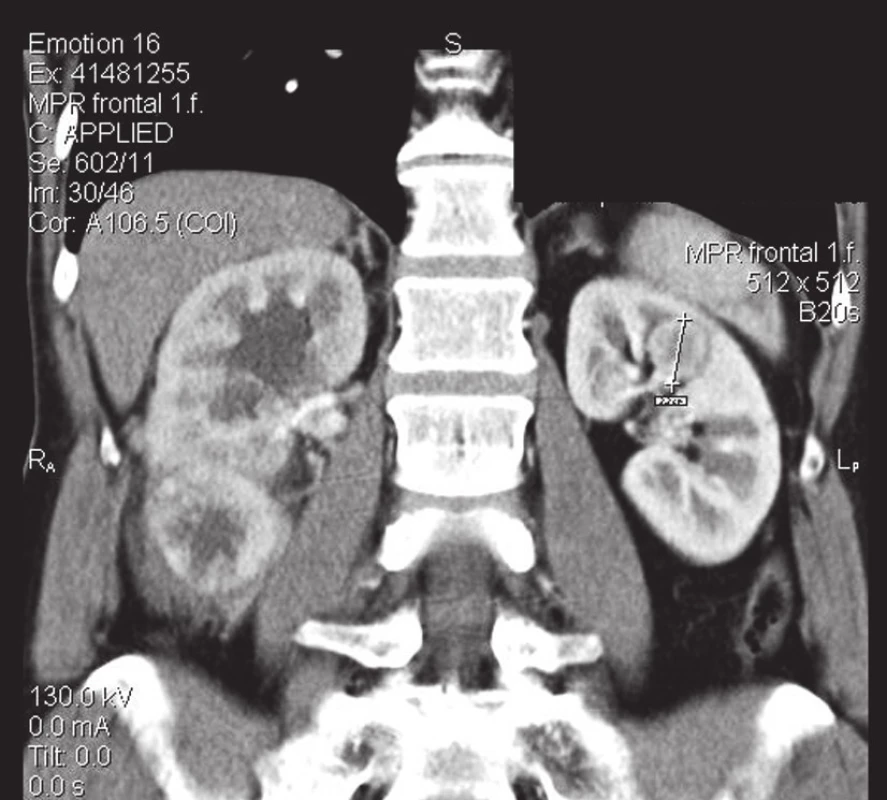 Tumor levé ledviny
Fig. 2. The tumor of the left kidney