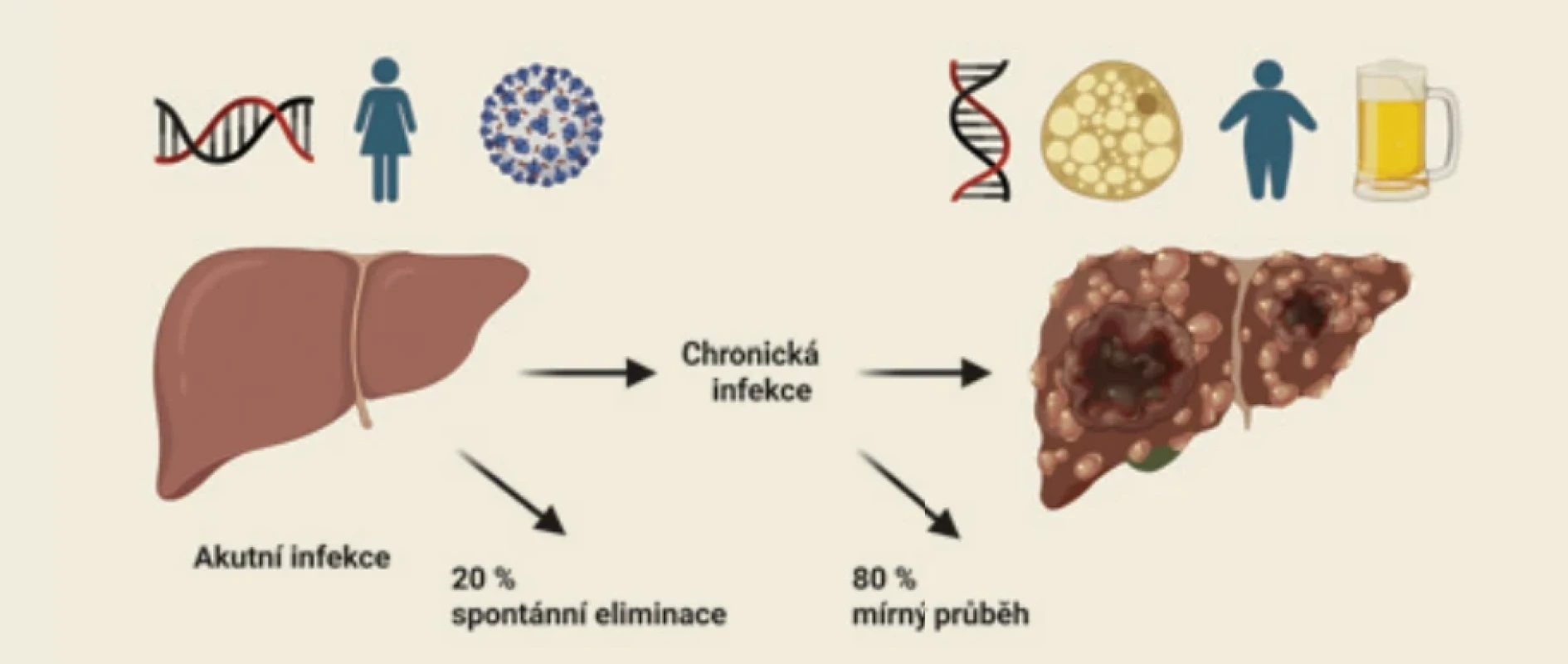 Přirozený průběh HCV infekce. Eliminaci viru v akutní fázi zásadně ovlivňuje nosičství příznivých alel IL28B, ženské pohlaví a quasispecies viru. K progresi fibrózy přispívá nosičství nepříznivých alel PNPLA3, steatóza jater, obezita a nadměrná dlouhodobá konzumace alkoholu. Vytvořeno pomocí BioRender.com podle [15–17]. Fig. 1. The natural course of HCV infection. Viral clearance during the acute phase is signifi cantly infl uenced by the presence of benefi cial IL28B alleles, female sex, and viral quasispecies. The progression of fi brosis is promoted by the presence of unfavorable PNPLA3 alleles, hepatic steatosis, obesity, and excessive long-term alcohol consumption. Created using BioRender.com based on [15–17].