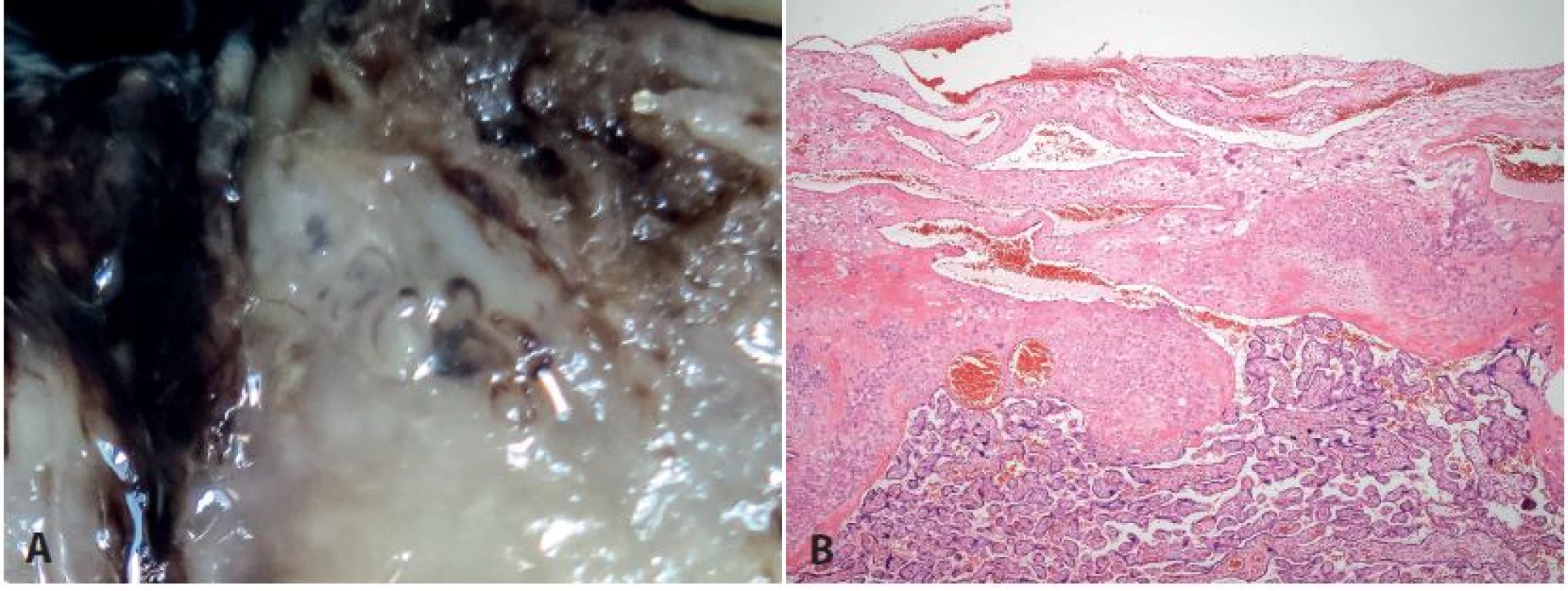 <b>Normální spirální arterie. A</b>: makrofoto z maternálního povrchu placenty - normální spirální arterie. <b>B</b>: normální spirální arterie (HE, zvětš. 40x).