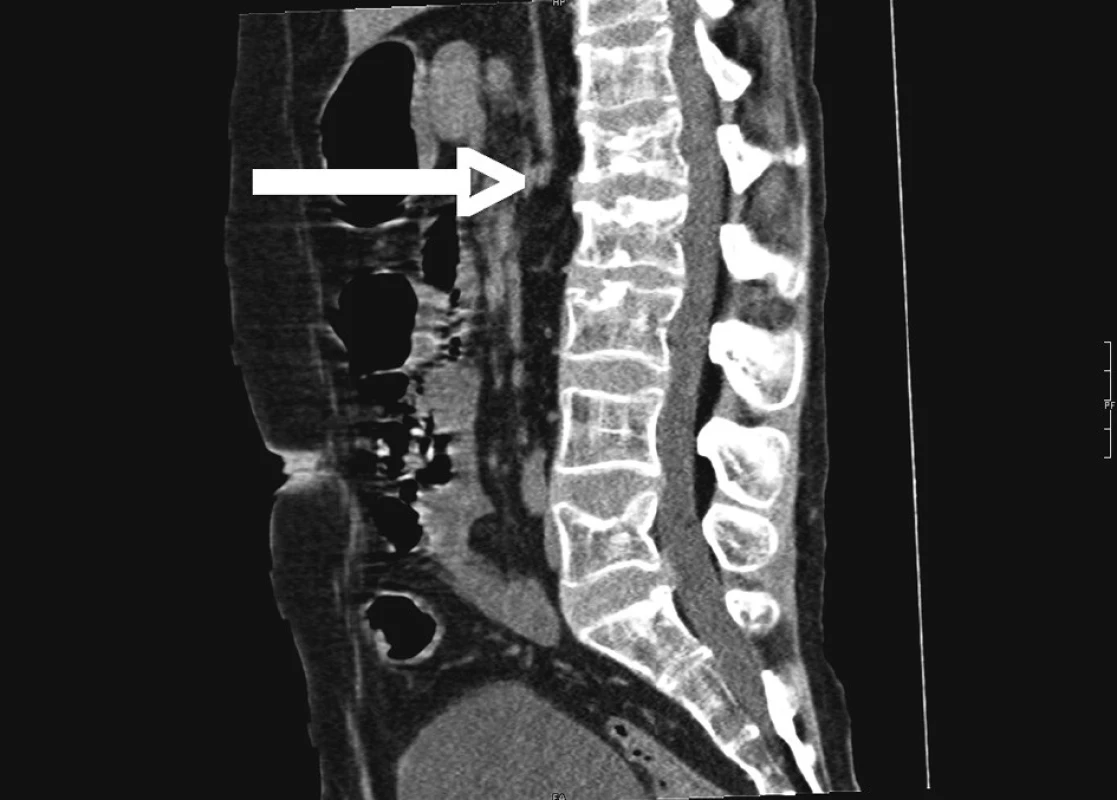 RTG chrbtice pacienta s ulceróznou kolitídou
Fig. 3. Spine X-ray picture of patient with UC