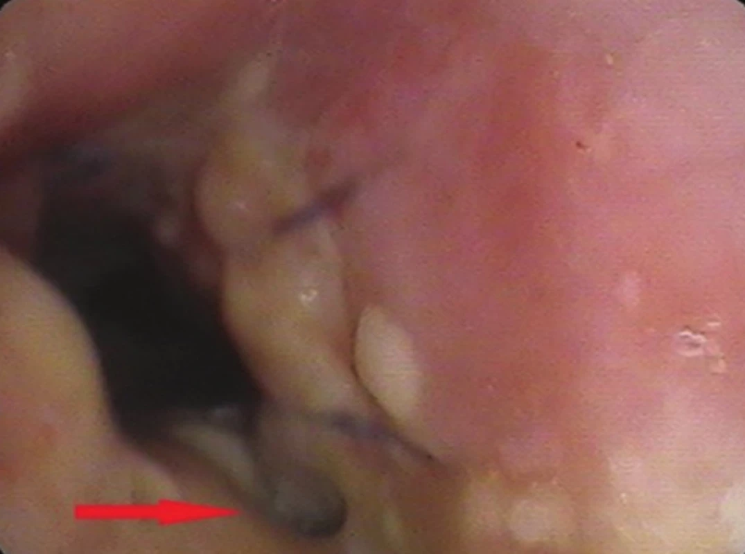 Bronchoskopický pohled: drobná píštěl v anastomóze (trachea - hlavní levý bronchus)
Fig. 5: Bronchoscopic view: small anastomotic fistula (trachea – left main bronchus)