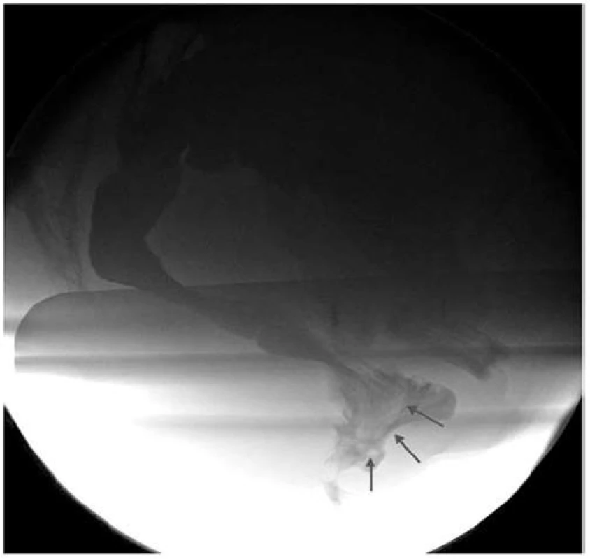 Hlava intususcepce (označeno šipkami) vstupující do análního kanálu.
Fig. 1. The top of intussusception entering into anal channel (arrows).