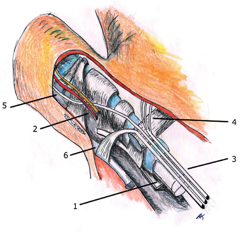 Anatomy of pretendinous fibers in the area of its transition to the fingers
1. Flexor tendons
2. Neurovascular bundle
3. Pretendinous fibres
4. Superficial fibers
5. Intermediary fibers
6. Deep fibers (an its course to dorsal extensor aponeurosis)