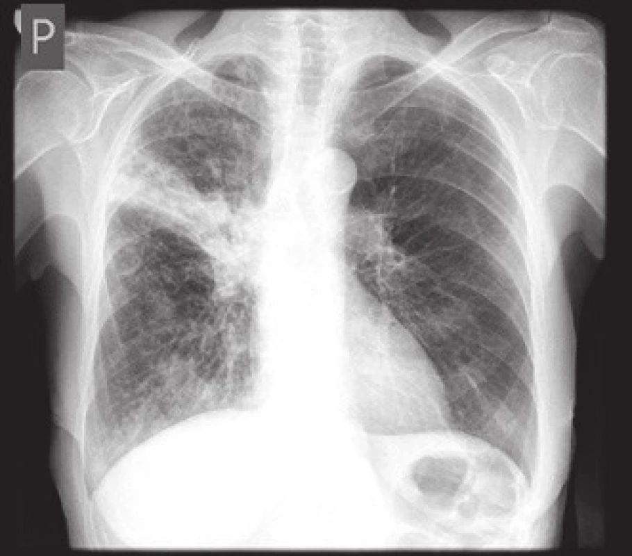 RTG obraz infiltrace vpravo ve středním plicním poli s vytažením a zvětšením pravého hilu.
Fig. 1. Chest X-ray image of infiltration of the right pulmonary mid-lobe with shift and enlargement of the right hilus.