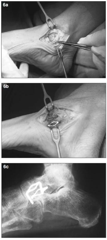<strong>a)</strong> peroperační snímek – talonavikulární kloub, prasklá šlacha m. tibialis  posterior, <strong>b)</strong> fixace kloubu 2 paměťovými skobkami, <strong>c)</strong> rtg snímek nohy po zhojené artrodéze talonavikulárního kloubu, fixace 2 paměťovými skobkami.