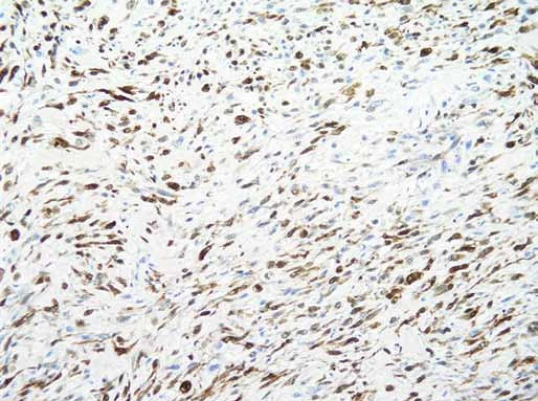 Histologický preparát.
Zvětšení 200× – IHC (imunohistologické vyšetření). V nádorových buňkách intenzivní exprese S-100 proteinu (hnědočerná barva).