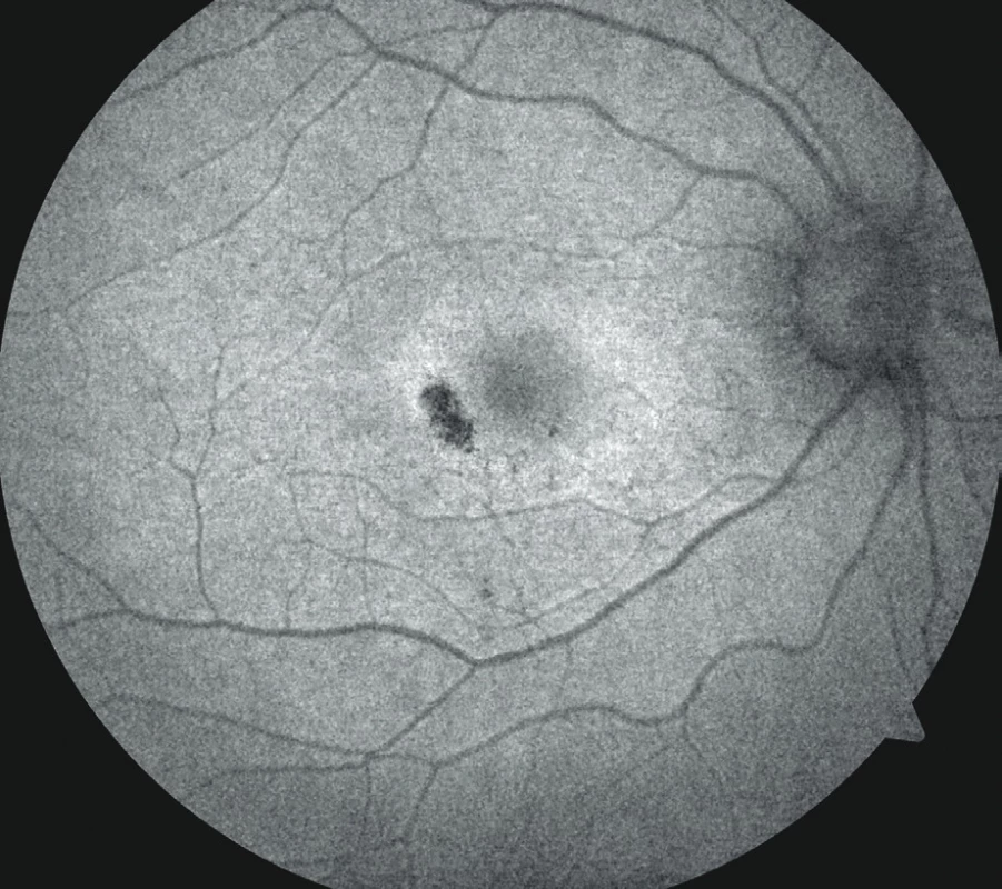 Autofluorescence lipofuscinu s prstencem mírně zvýšené intenzity okolo fovey, ložisko atrofie RPE bez autofluorescence