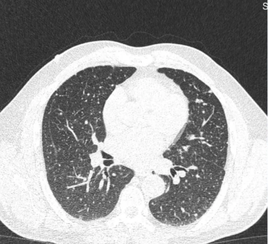 Mikronodulární postižení plic u pacienta s plicní BCGitis. Zdroj: Archiv Krajské nemocnice Liberec. Fig. 1. Micronodular pulmonary involvement in a patient with pulmonary BCGitis. Source: Regional Hospital Liberec archive. 