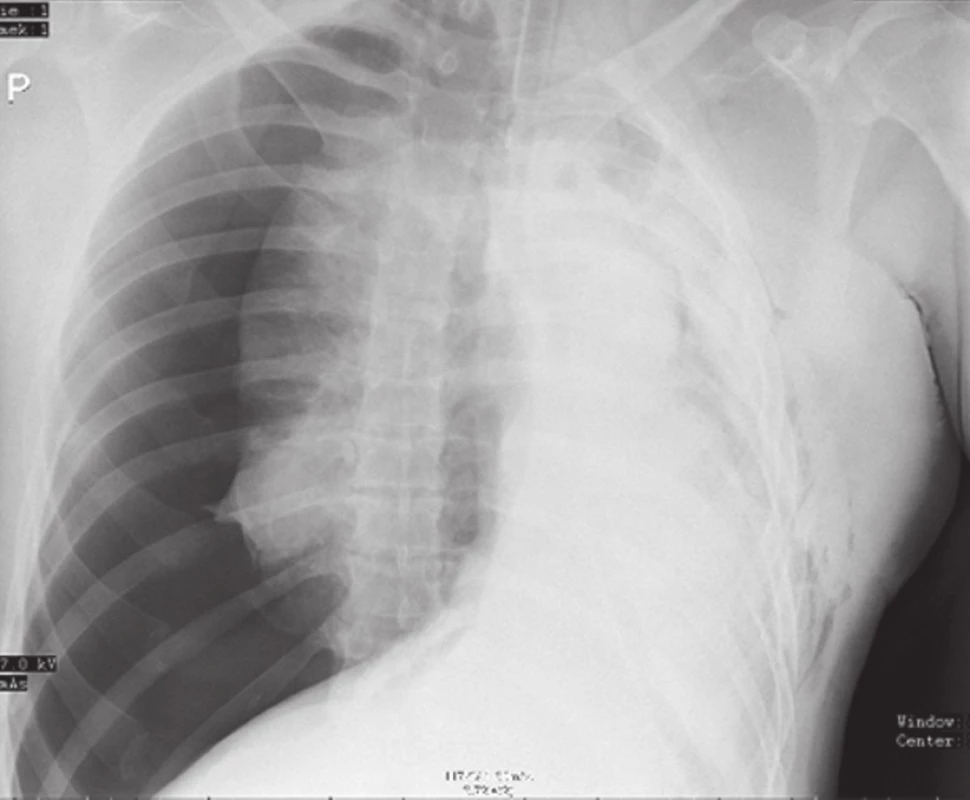 RTG obraz pravostranného traumatického tenzního pneumotoraxu
Fig. 1: X-ray image of right-sided traumatic tension pneumothorax