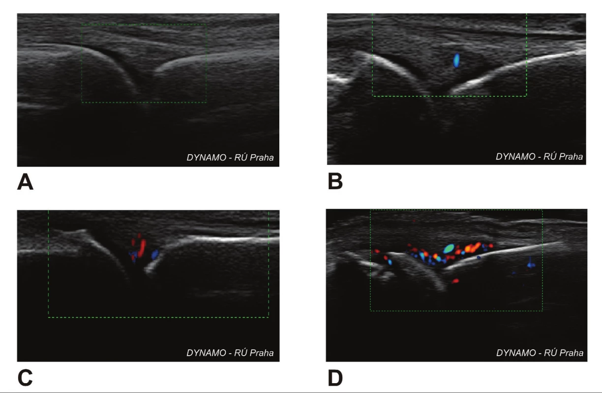 Synovialitida metakarpofalangeálních kloubů zobrazená Power Dopplerem. A. stupeň 0; B. stupeň 1; C. stupeň 2; D. stupeň 3. Zdroj: Archiv Revmatologického ústavu, Praha.