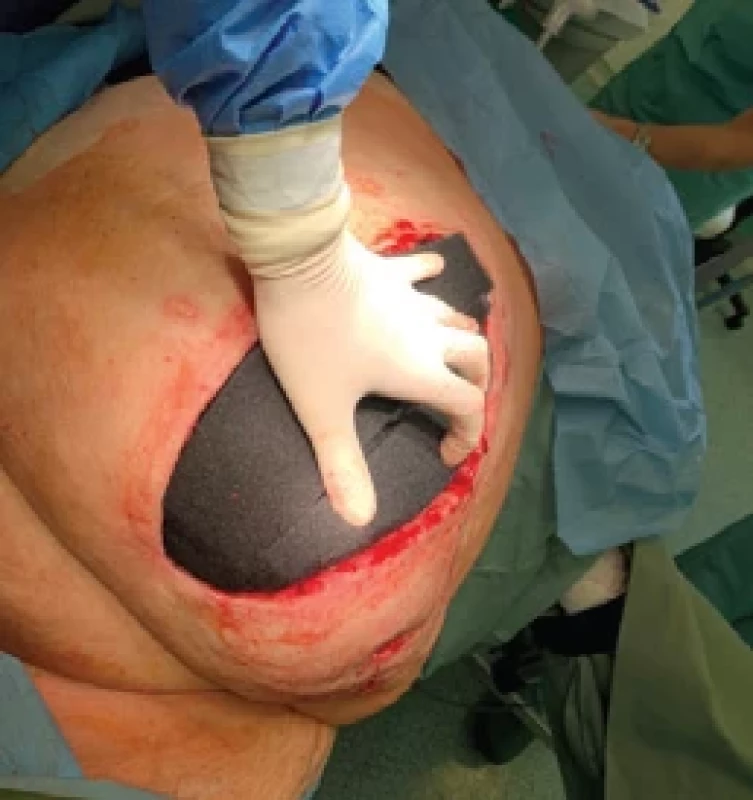 Vložení polyuretanové pěny upravené podle tvaru rány a vyplnění defektu. Fig. 4. Insertion of polyurethane foam trimmed to the wound shape to fi ll the defect.