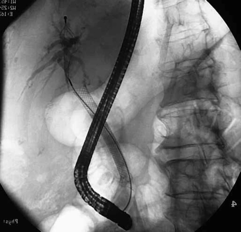 ERCP: metalický stent, obturace jeho proximální třetiny progredujícím tumorem.
Fig. 2. ERCP: metalic stent, obturation of its proximal third by tumor masses.
