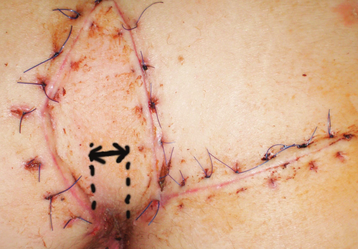 Fotografia rany 12 dní po operácii – modifikovaný Limbergov lalok (šípka naznačuje vzdialenosť spodného pólu plastiky od mediálnej roviny).
Obr. 3. Photograph of wound 12 days after surgery – modified Limberg flap (arrow shows distance of down corner of flap and medial line).
