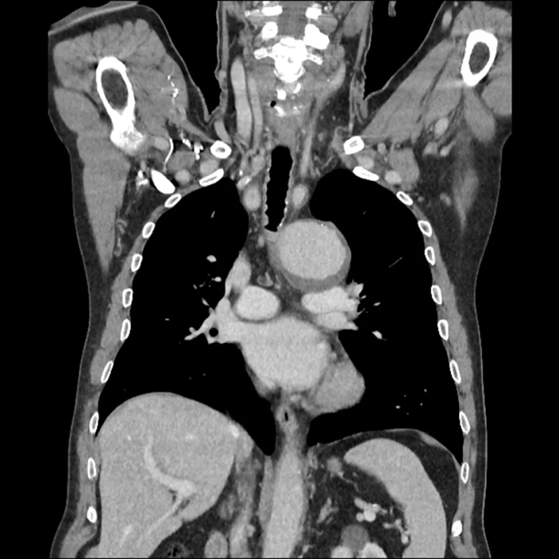 Aneurysma oblouku aorty – kontrastní CT vyšetření hrudníku, koronární projekce