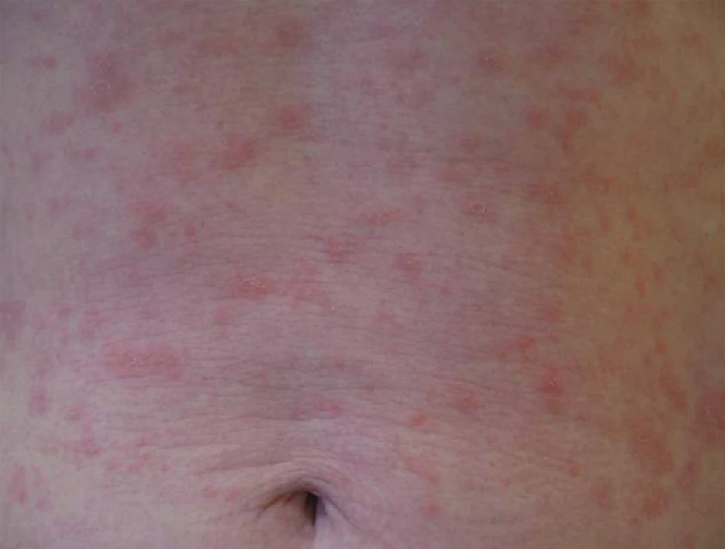 Syphilis secundaria – maculopapulosa.