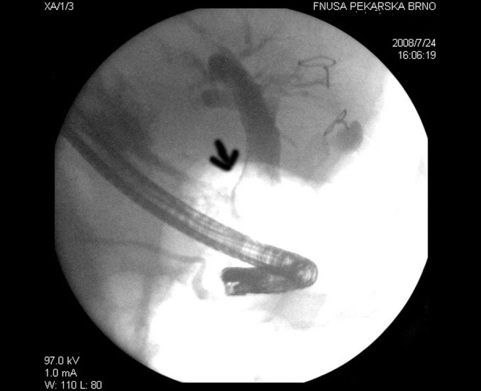 První ERCP, šipka ukazuje filiformní stenózu choledochu