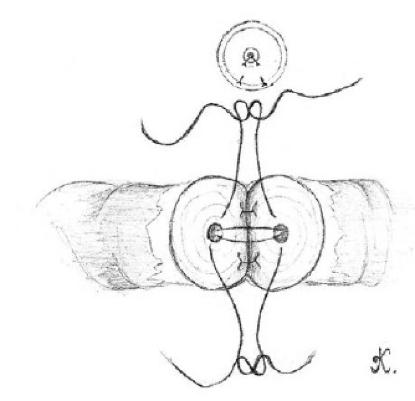 Přiblížení zadní slizniční vrstvy obou konců chámovodu pomocí dvou dvojitých 10-0 nylonových stehů
Fig. 1. The approximation of the posterior mucosal layer for both ends of vas deferens with two double armed 10-0 nylon sutures