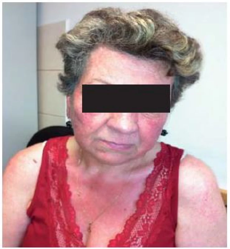 Rosacea, notice the congestion of conjunctiva – in ocular rosacea.
Obr. 2. Rosacea s opuchnutím spojoviek – u očnej rosacey.