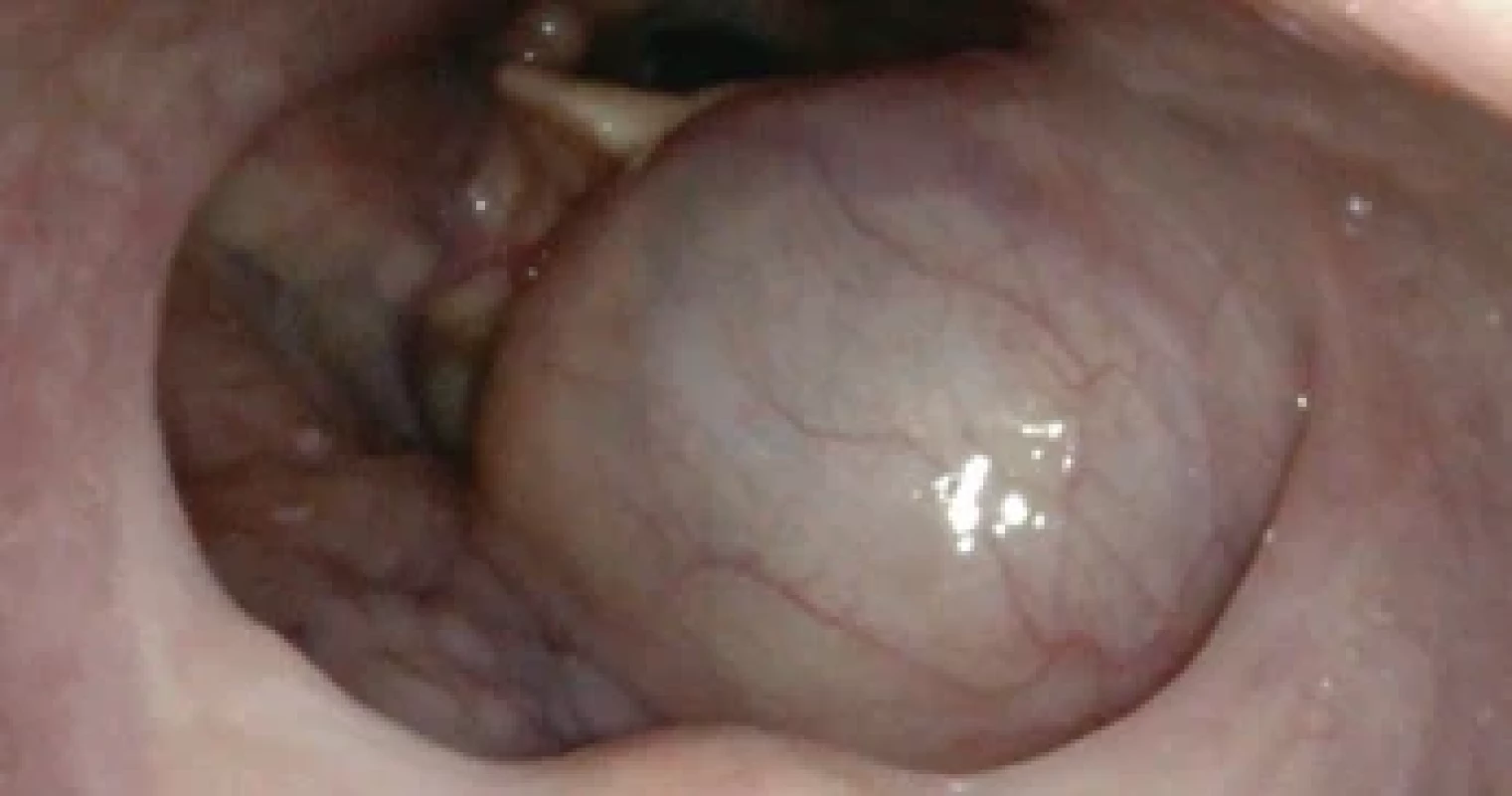 První vyšetření fl exibilní laryngoskopii – levá polovina epiglottis překryta cystickým útvarem v oblasti kořene jazyka.First examination of fl exible laryngoscopy – the left half of the epiglottis
covered by a cystic formation in the area of the tongue base.