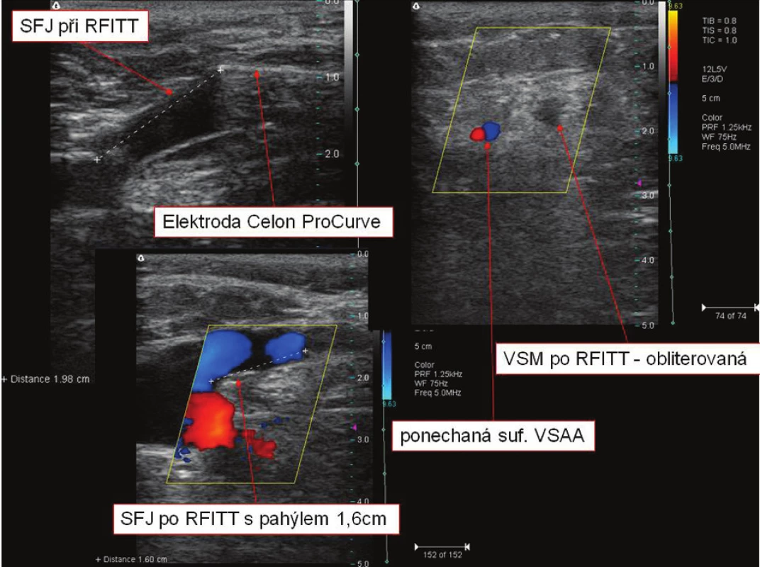 SFJ při a po endovaskulární operaci RFITT, VSM po RFITT (RFITT = Radiofrequent Induced Thermo-Terapy)
Fig. 5. SFJ during and after endovascular RFITT surgery, VSM after RFITT (RFITT = Radiofrequent Induced Thermo- Terapy),