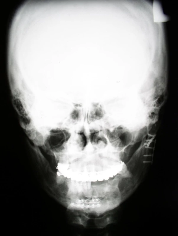 Osteosyntéza těla a kloubního výběžku dolní čelisti