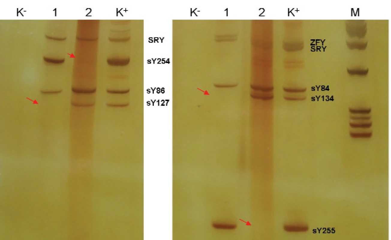 Výsledek vyšetření mikrodelece AZF a,b,c.
1 - pacient - delece AZF b
2 - pacient - delece AZF c
K+ pozitivní kontrola
K- negativní kontrola
M - marker molekulových hmotností
detekce oblasti AZFa: sY84, sY86,
detekce oblasti AZFb: sY127, sY134
detekce oblasti AZFc: sY254, sY255
