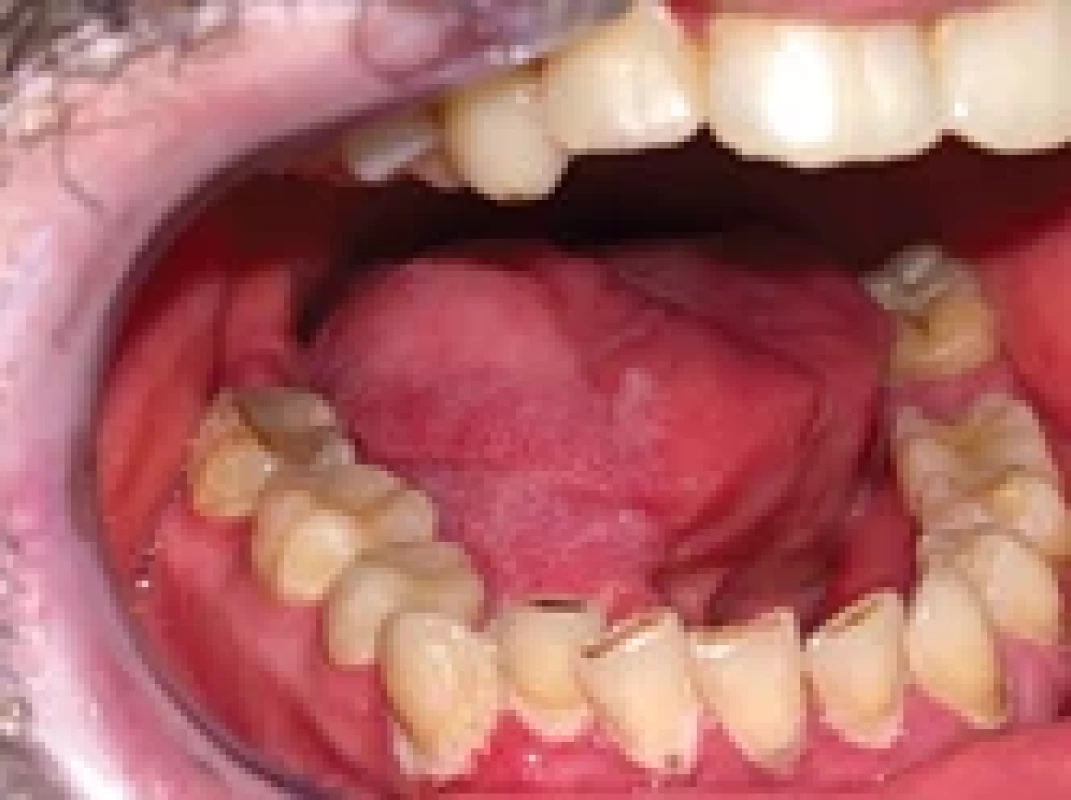 Reconstruction after right- -sided hemiglosectomy with the radial forearm free fl ap.