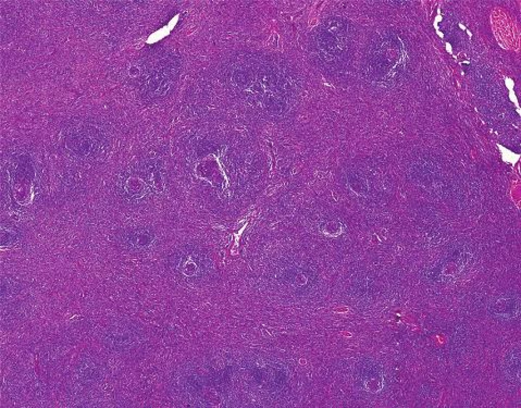 Histologický obraz hyalinně vaskulárního typu Castlemanovy choroby
Fig. 3: Histological picture of hyalin-vascular type of Castleman´s disease