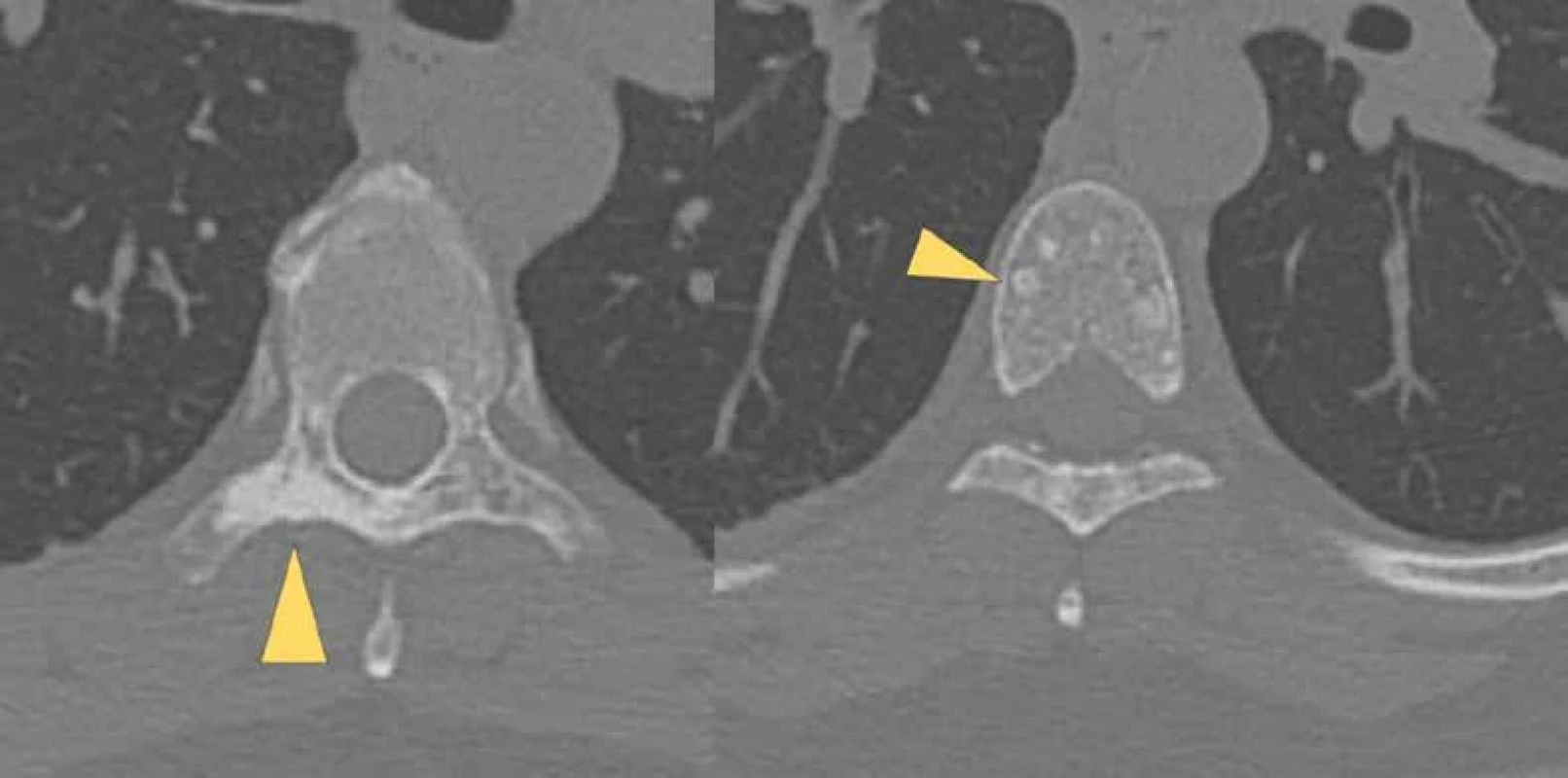 CT hrudní páteře – sklerotická ložiska skeletu páteře (foto: doc. MUDr. Zbyněk Tüdös, Ph.D., Radiologická klinika FN Olomouc)