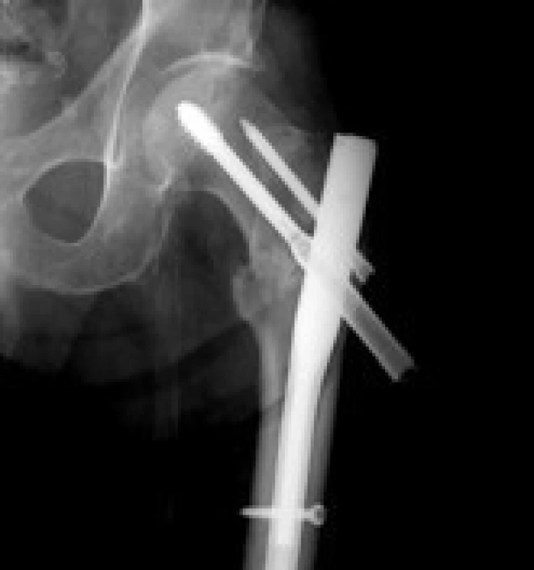 Snímek 3 měsíce od operace – dislokace skluzného pouzdra laterálně