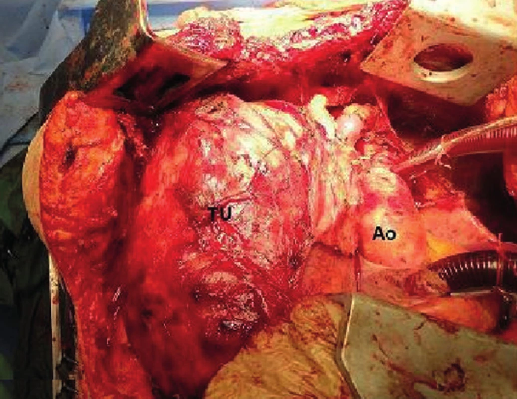 Tumor, kazuistika 3
Fig. 4: Tumor, case report 3