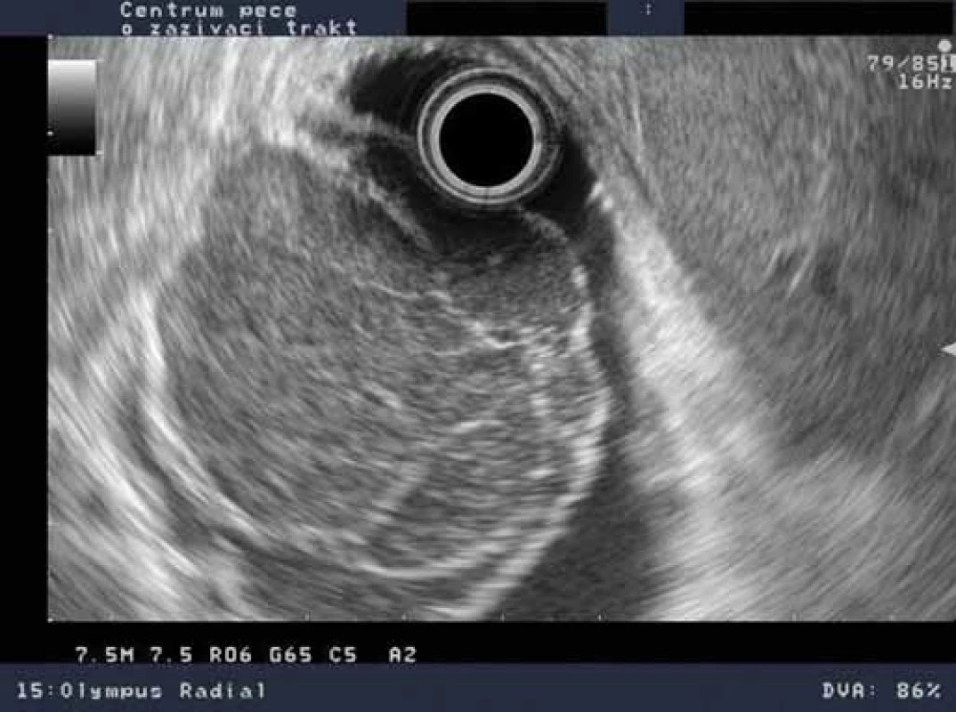 EUS nález s progresí – hypoechogenní léze 47 × 45 × 50 mm vycházející ze 2. echovrstvy.
Fig. 3. EUS findings with progression – hypoechoic lesion 47 × 45 × 50 mm originating from the 2<sup>nd</sup> echolayer.