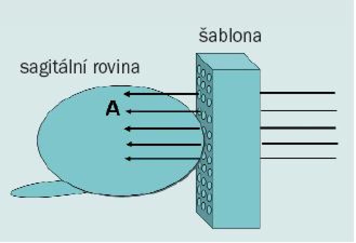 Diagram zobrazující transperineální biopsii s použitím template (šablony). Tkáň z anteriorní distální části prostaty (A) lze snadno získat pomocí perineálního přístupu.