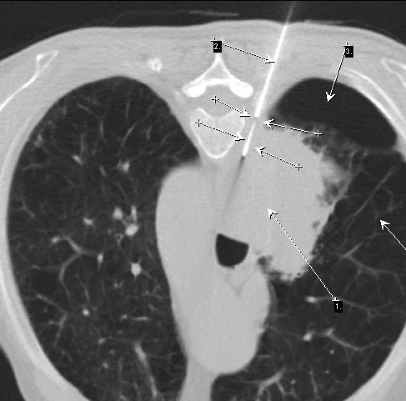 Negativní bronchoskopie u objemného tumorózního ložiska v šestém segmentu pravého dolního laloku plic (šipka 1) obklopené emfyzematózní tkání (šipky 3)
Bioptická jehla (šipka 2) je vedena přísně paravertebrálně v pleurálním prostoru (šipky). Adenokarcinom.