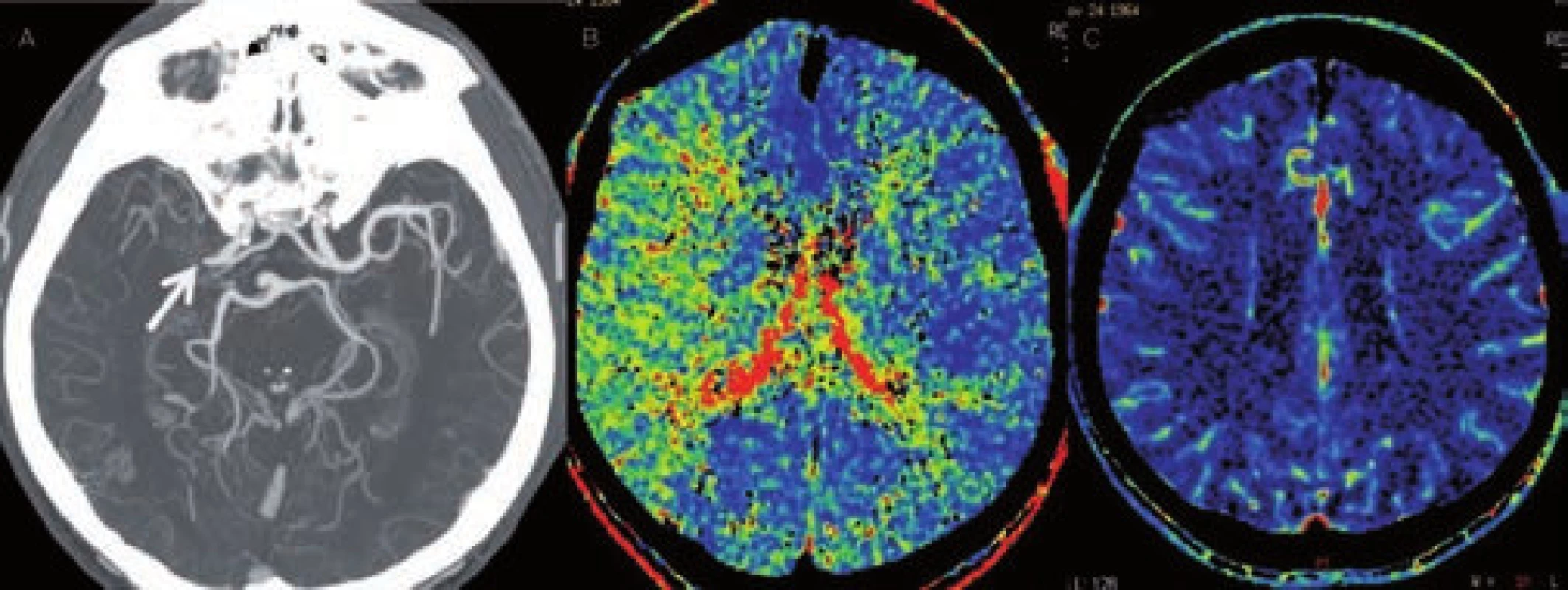 Chronická, kompenzovaná okluze ACM s dobrým kolaterálním oběhem. A – CT angiografie s nálezem okluze M1 úseku ACM, B – prodloužené MTT v povodí ACM vpravo, C – normální CBV.