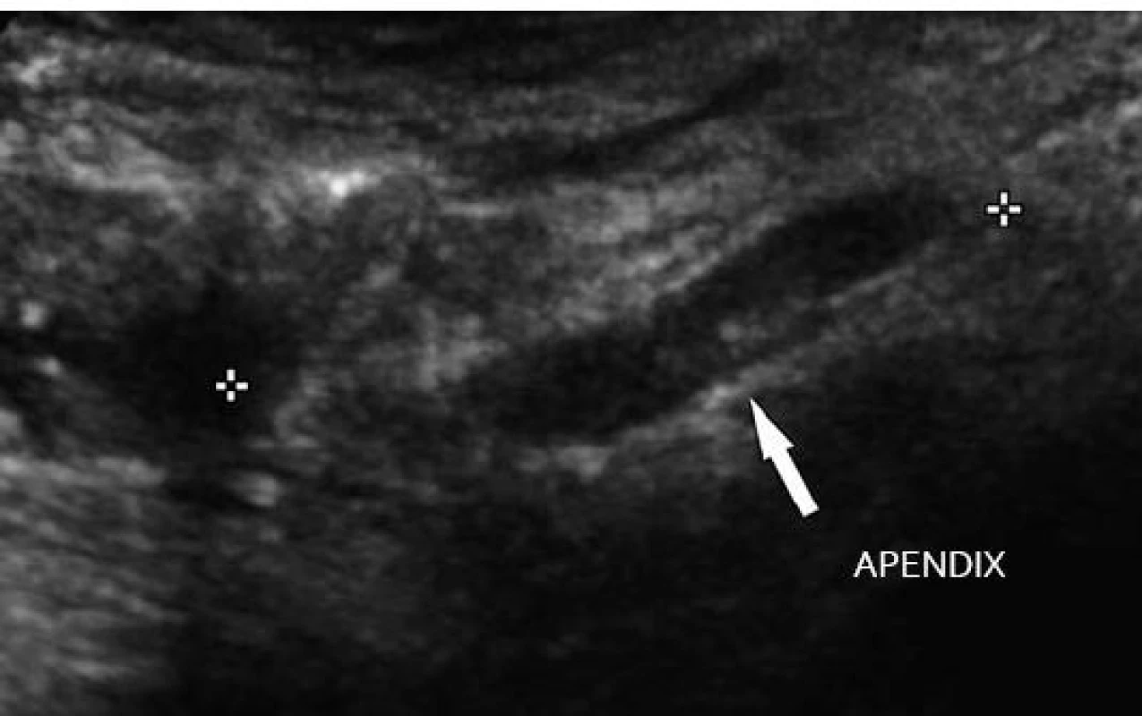 Akutní apendicitida – zesílení stěny a průsvitu lumen.
Fig. 1. Acute appendicitis – thickening of the appendix walls and of the lumen.