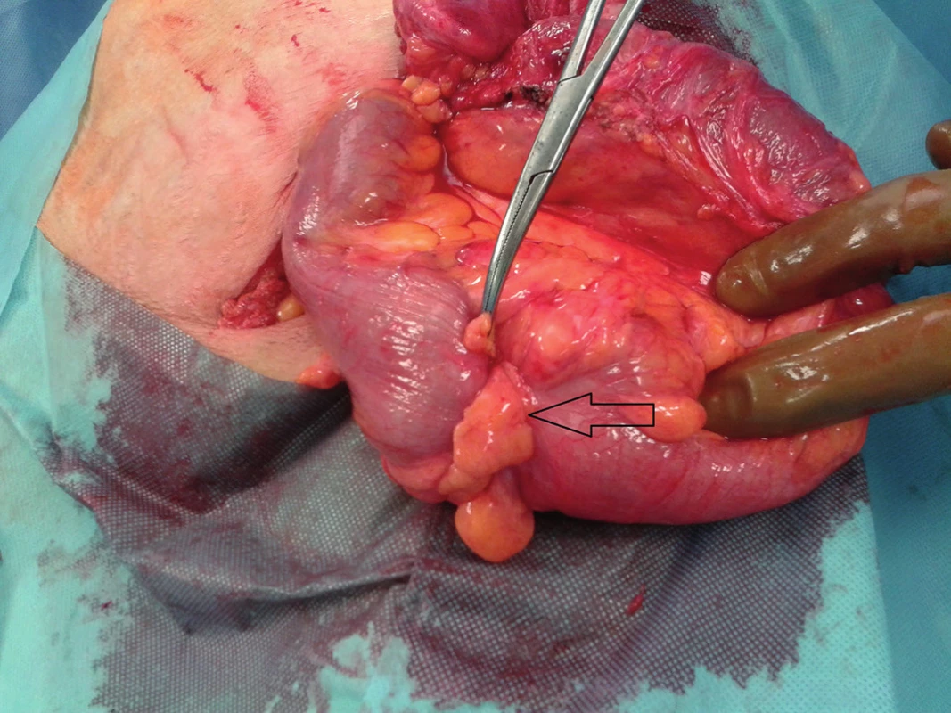 Tumor sigmy v ľavostrannej slabinovej prietrži
Fig. 1: The sigmoid tumour is herniated into the left inguinal hernia