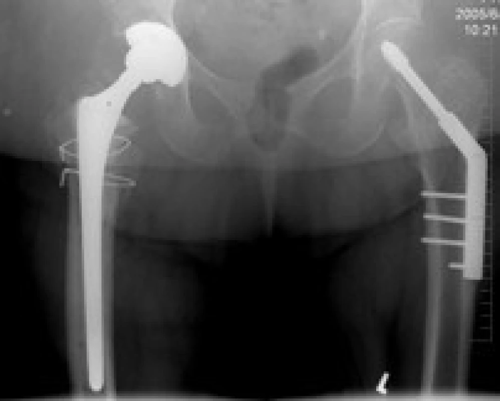Implantace TEP se 2 pomocnými cerklážemi