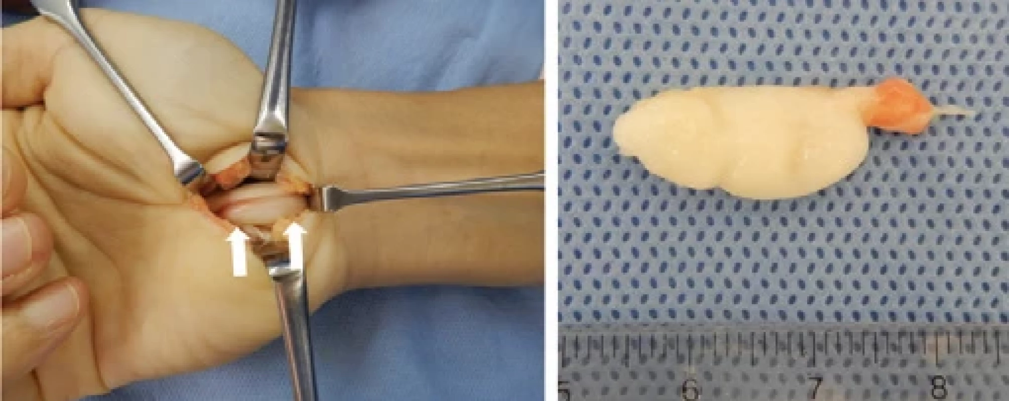 Photographs of intraoperative fi ndings. a) Macroscopic view. Intraoperatively, a white colored mass was identifi ed around the fl exor digitorum profundus tendon of the middle fi nger (white arrow); b) the excised tissue.