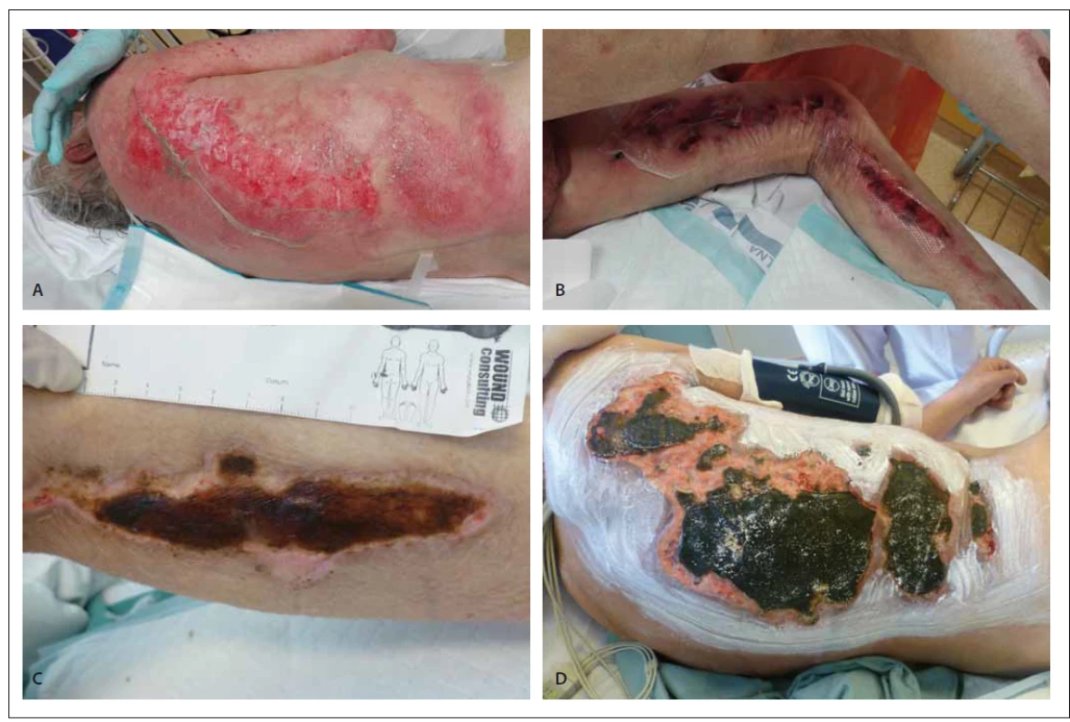 Patient, 73-years-old man, living alone, visited by son. Found unconscious in his garden. Admitted to hospital with position trauma,
dehydration and rhabdomyolysis. After admission, hypotension, hyperthermia and large position trauma with max. changes on lateral dorsal
side of torso and lower limbs. Patient is a chronic ethylic (A–D).<br>
Obr. 4. Pacient, 73letý muž, žije sám, navštěvuje ho syn. Tři dny ležel na zahradě v bezvědomí, při přijetí hypotenze, hypertermie a rozsáhlé
trauma s maximem změn v oblasti trupu laterodorzálně l.dx. a dolních končetin. Přijat jako poziční trauma s dehydratací a rhabdomyolýzou
k terapii. Pacient závislý na alkoholu (A–D).