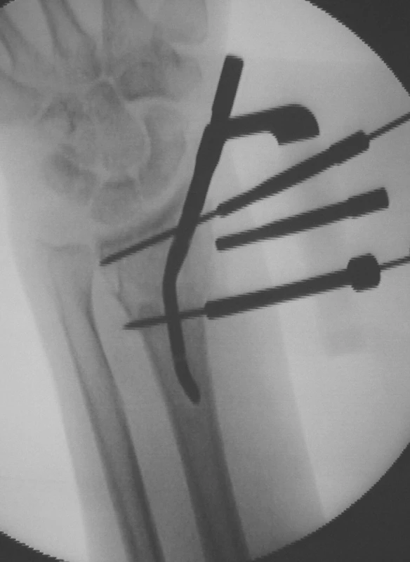 Peroperační RTG ve fázi před zavedením jistících šroubů. Po zavedení hřebu již není možná korekce postavení ve zlomenině
Fig. 3. Intraoperative X-ray prior to introduction of stabilization screws. Once the nail is introduced, no correction of its positioning in the fractured bone is possible