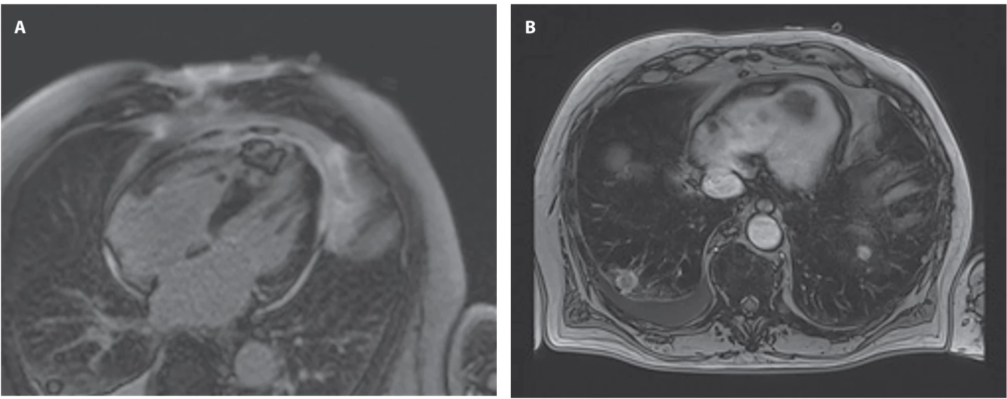 Selected cardiac MRI images demonstrating the apically located metastasis. (A) Late gadolinium enhancement (LGE) scan  showing involvement of the apex; (B) T1-weighted, axial (transverse) 3D GRE Dixon image (also showing lung metastases).