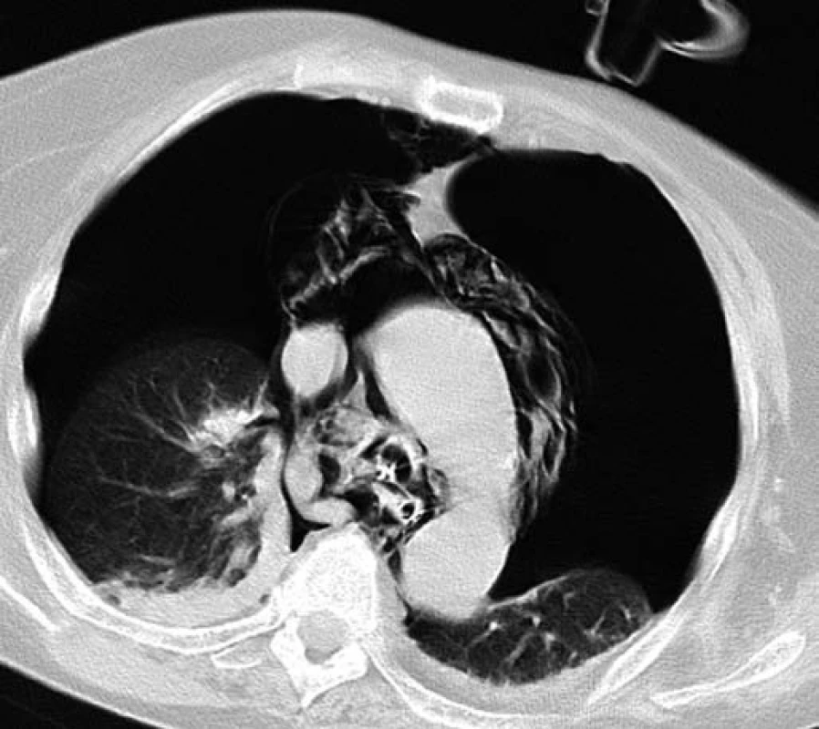 CT plic – bilaterální pneumothorax.
Fig. 2. CT of the lungs - bilateral pneumothorax.