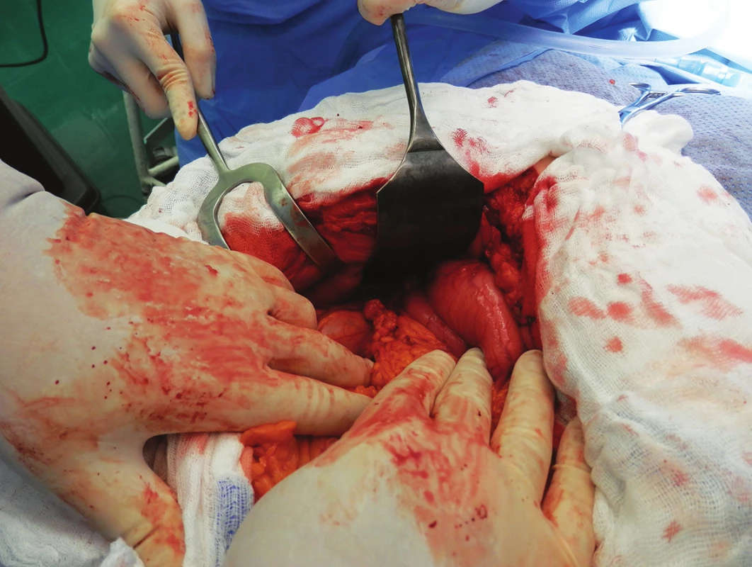 Infiltrát žlučníku, duodena a jaterního ohbí tlustého střeva
Fig. 4: Infiltration of the gallbladder, duodenum and hepatic flexure of colon